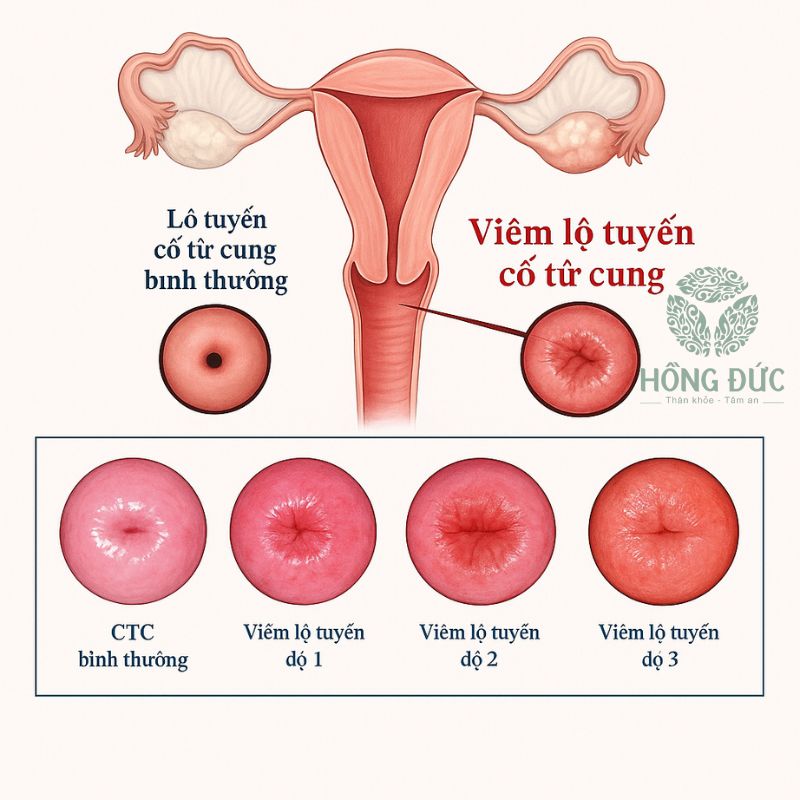 Thuốc đặc trị viêm lộ tuyến cổ tử cung 3 14