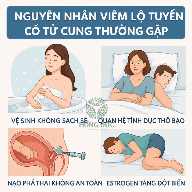 Chữa viêm lộ tuyến cổ tử cung đúng cách: Điều bạn cần biết để bảo vệ sức khỏe sinh sản 3 15