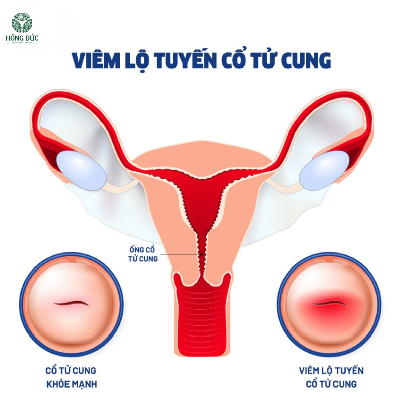 Điều trị viêm lộ tuyến bằng Samya: Giải pháp tự nhiên, hiệu quả cho phụ nữ hiện đại 3 2