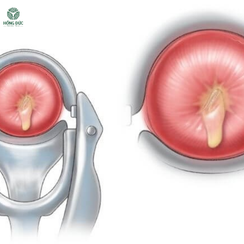 Điều trị viêm lộ tuyến cổ tử cung: Phương pháp hiệu quả và an toàn cho phụ nữ hiện đại 3 22