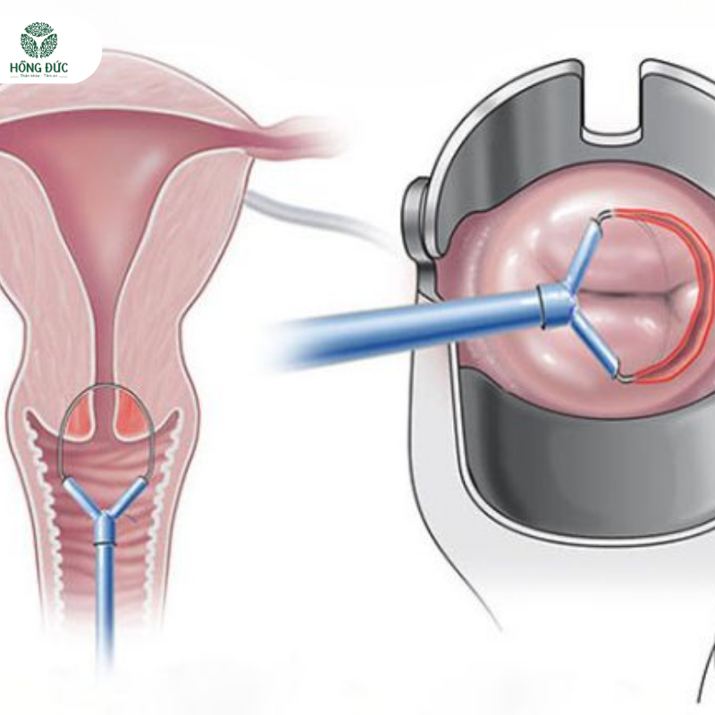 Điều trị viêm lộ tuyến cổ tử cung: Phương pháp hiệu quả và an toàn cho phụ nữ hiện đại 4 23