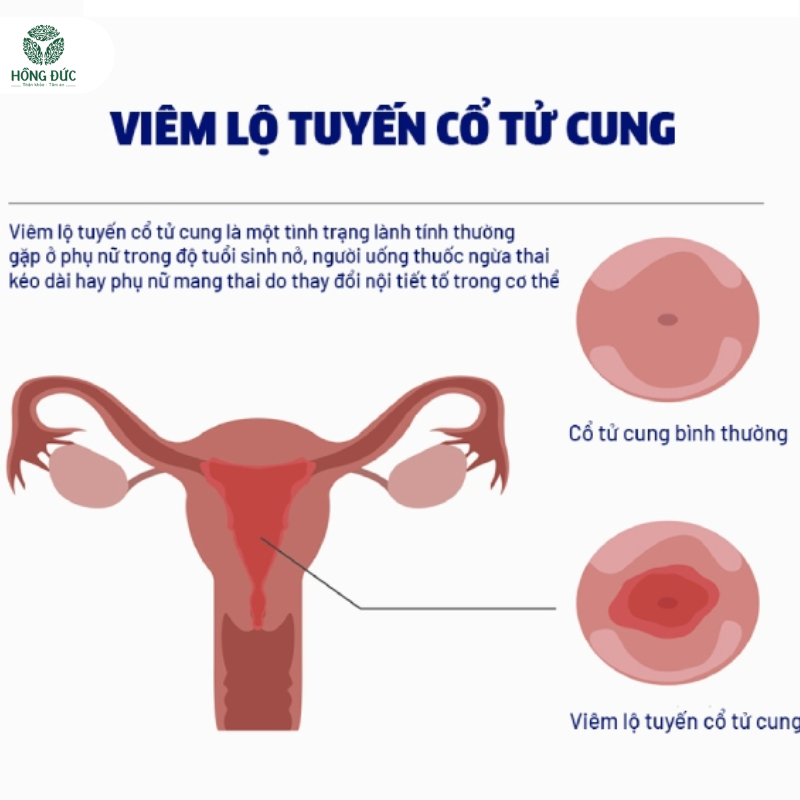 Thuốc trị viêm lộ tuyến: Hướng dẫn chi tiết từ chuyên gia phụ khoa 7 Viêm Lộ Tuyến Cổ Tử Cung