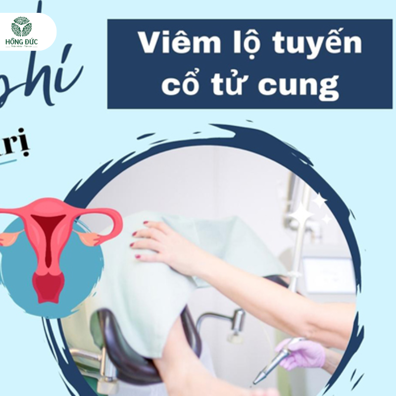 Chi phí điều trị viêm lộ tuyến cổ tử cung: Cập nhật mới nhất và những điều cần biết 1 Những chi phí điều trị Viêm Lộ Tuyến Cổ Tử Cung