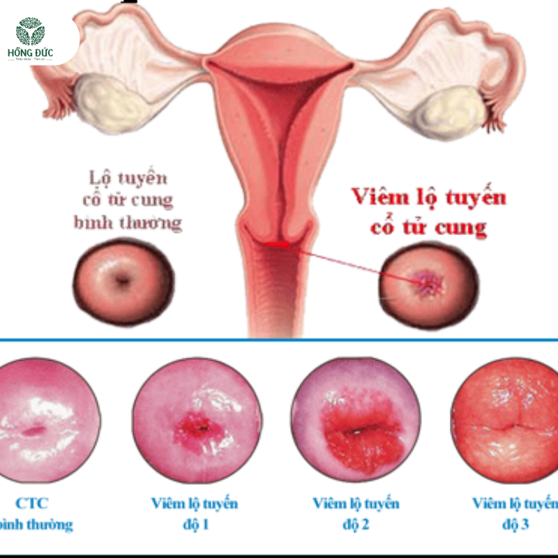 Phác đồ điều trị viêm lộ tuyến tử cung: Hướng dẫn chi tiết và hiệu quả 13 7