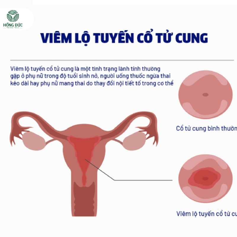 Viêm Lộ Tuyến Cổ Tử Cung